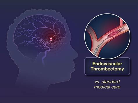 hermes trial stroke|endovascular thrombectomy stroke trial.